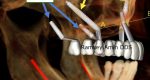 Pterygoid-2 Pterygoid-2