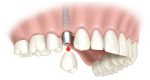 single tooth single tooth